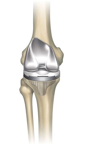 total knee graphic